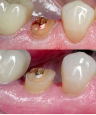 جراحی CL دندان