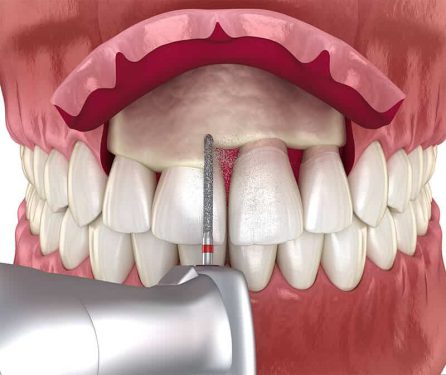 جراحی افزایش طول تاج دندان قیمت 