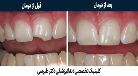 قبل و بعد از پر کردن دندان پوسیده شده