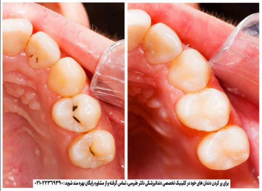پر کردن دندان در کلینیک تخصصی دکتر طبرسی
