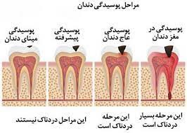 مراحل به عصب رسیدن دندان