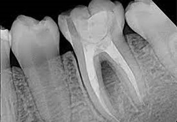 رادیوگرافی دندان عصب کشی شده