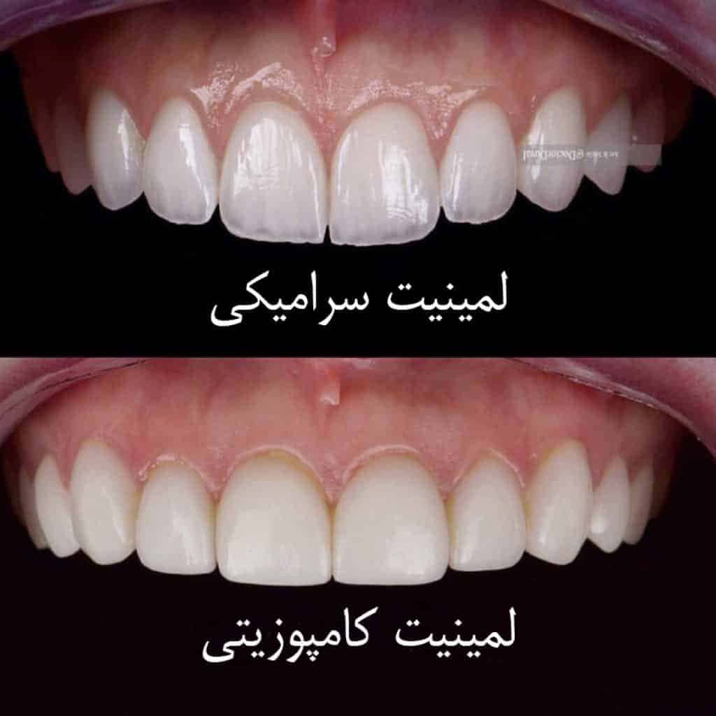 لمینت سرامیکی یا لمینت کامپوزیت