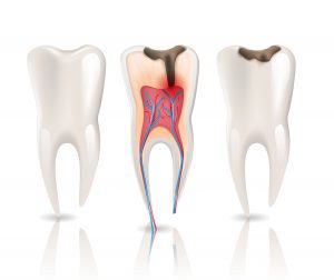 پوسیدگی عصب کشی درد دندان
