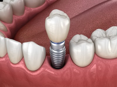 تصویر ایمپلنت دندان