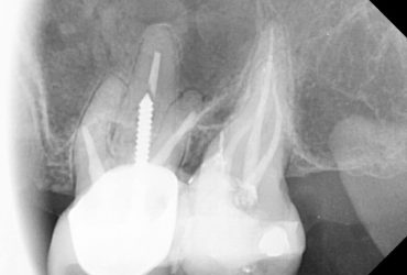 رادیوگرافی دندان عصب کشی شده