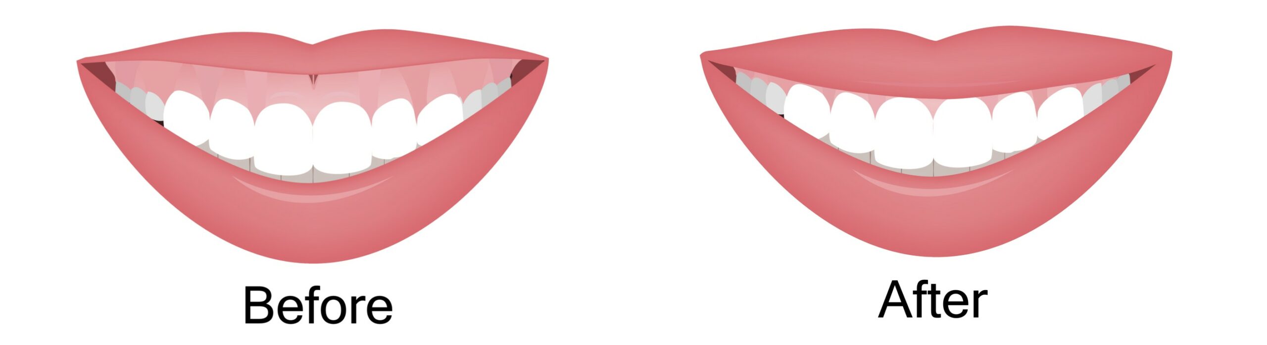 gummy smile