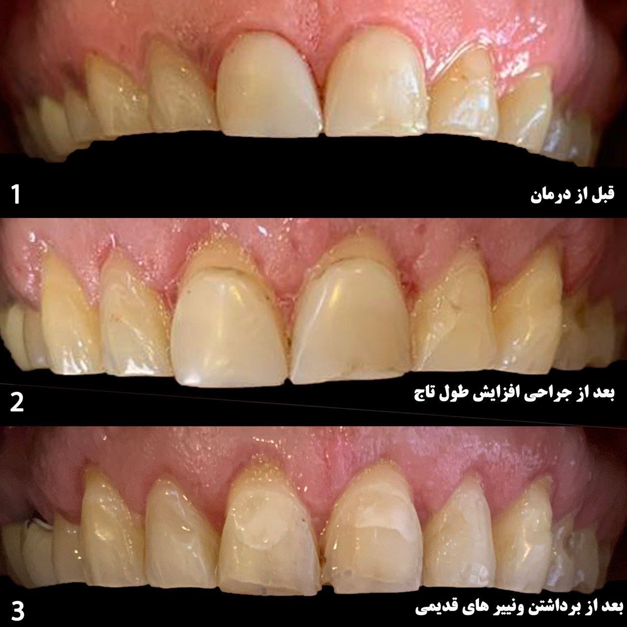 جراحی لثه
