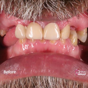 نمونه کار ایمپلنت دندان 4
