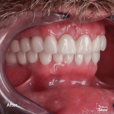 نمونه کار ایمپلنت دندان 5