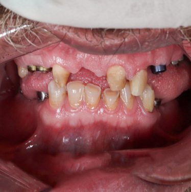 نمونه کار ایمپلنت دندان 2