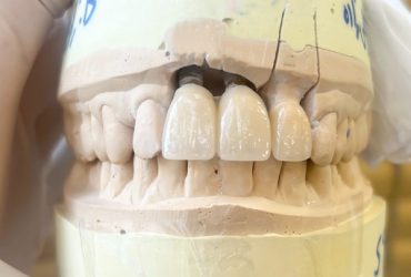 قالب ایمپلنت دندان