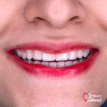 نمونه کار بیمار زیبایی دندانپزشکی
