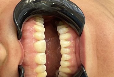 نمونه کار جراحی لثه و کامپوزیت دندان