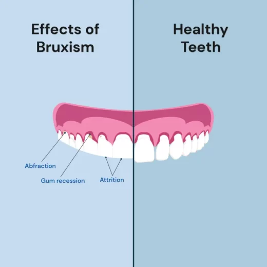ساییده شدن دندان ها بر اثر دندان قروچه