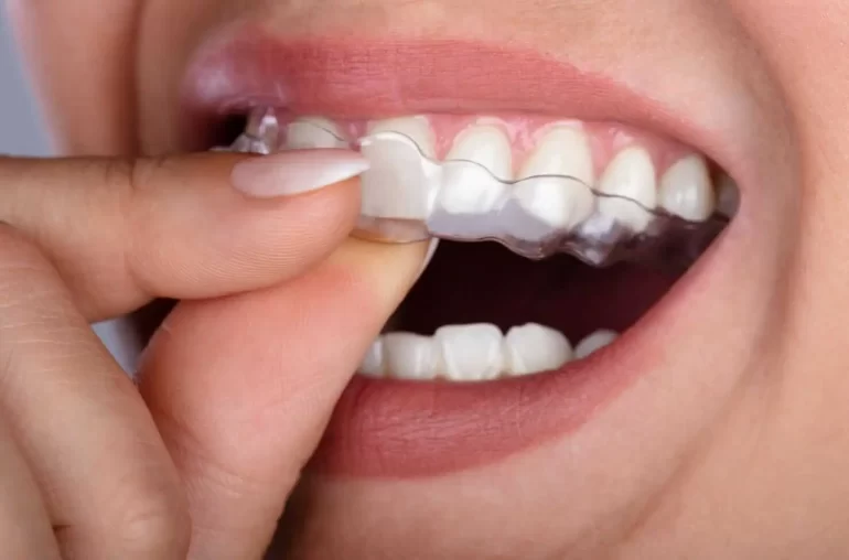 bruxism mouth guard 1.jpg