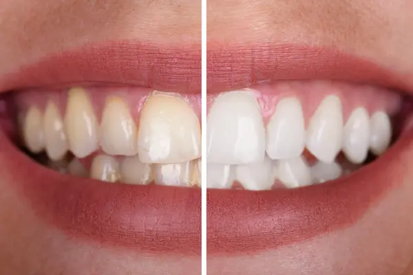 bleaching before and after